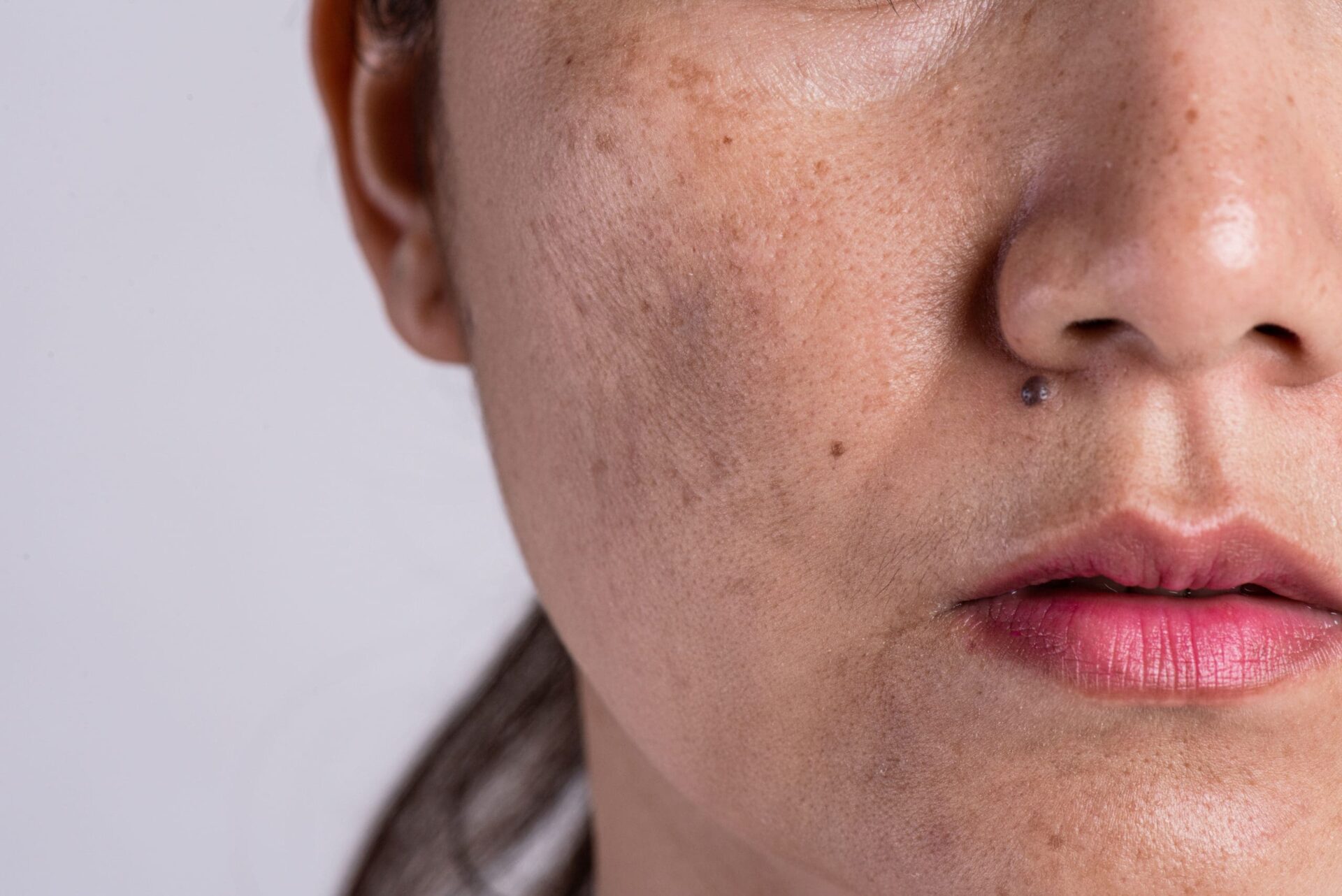 Penyebab, Pengobatan, dan Tips Efektif Mengatasi Melasma Wajah