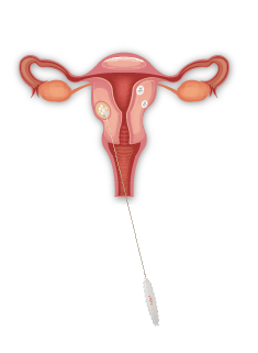 Pengobatan mioma uteri