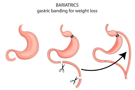 Operasi bariatrik