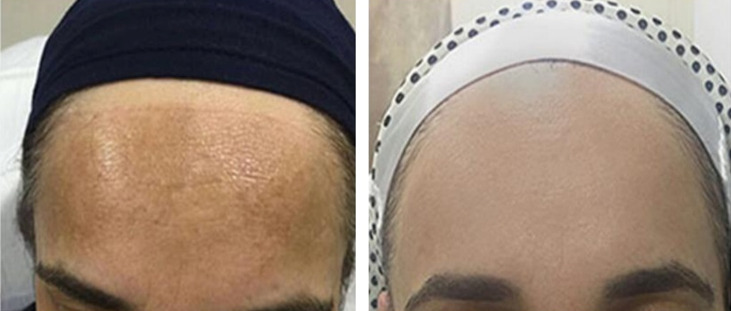 Apa itu melasma