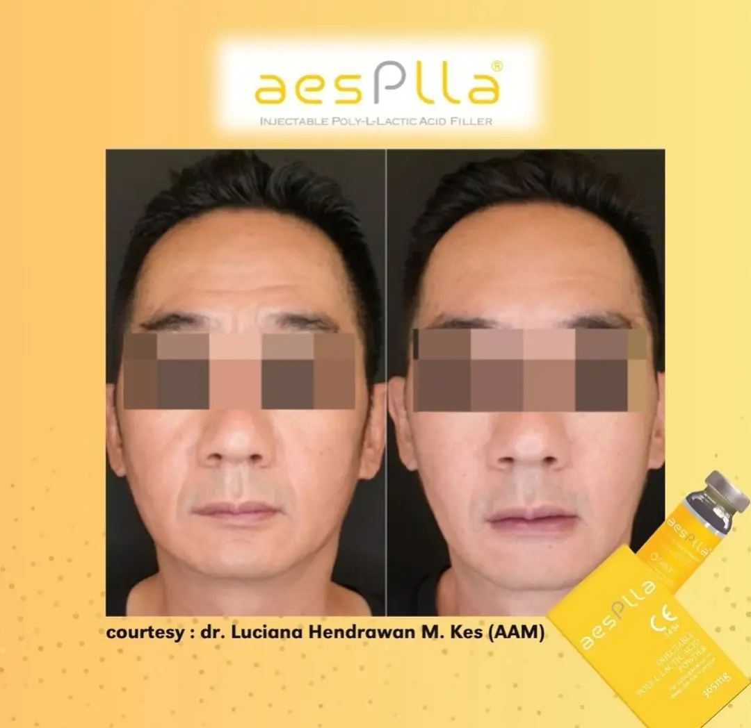 cara menggemukkan pipi