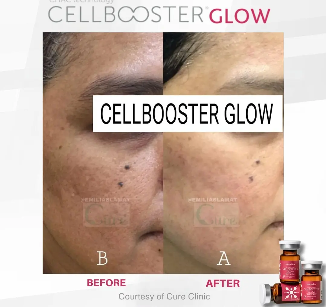 Skincare untuk hiperpigmentasi