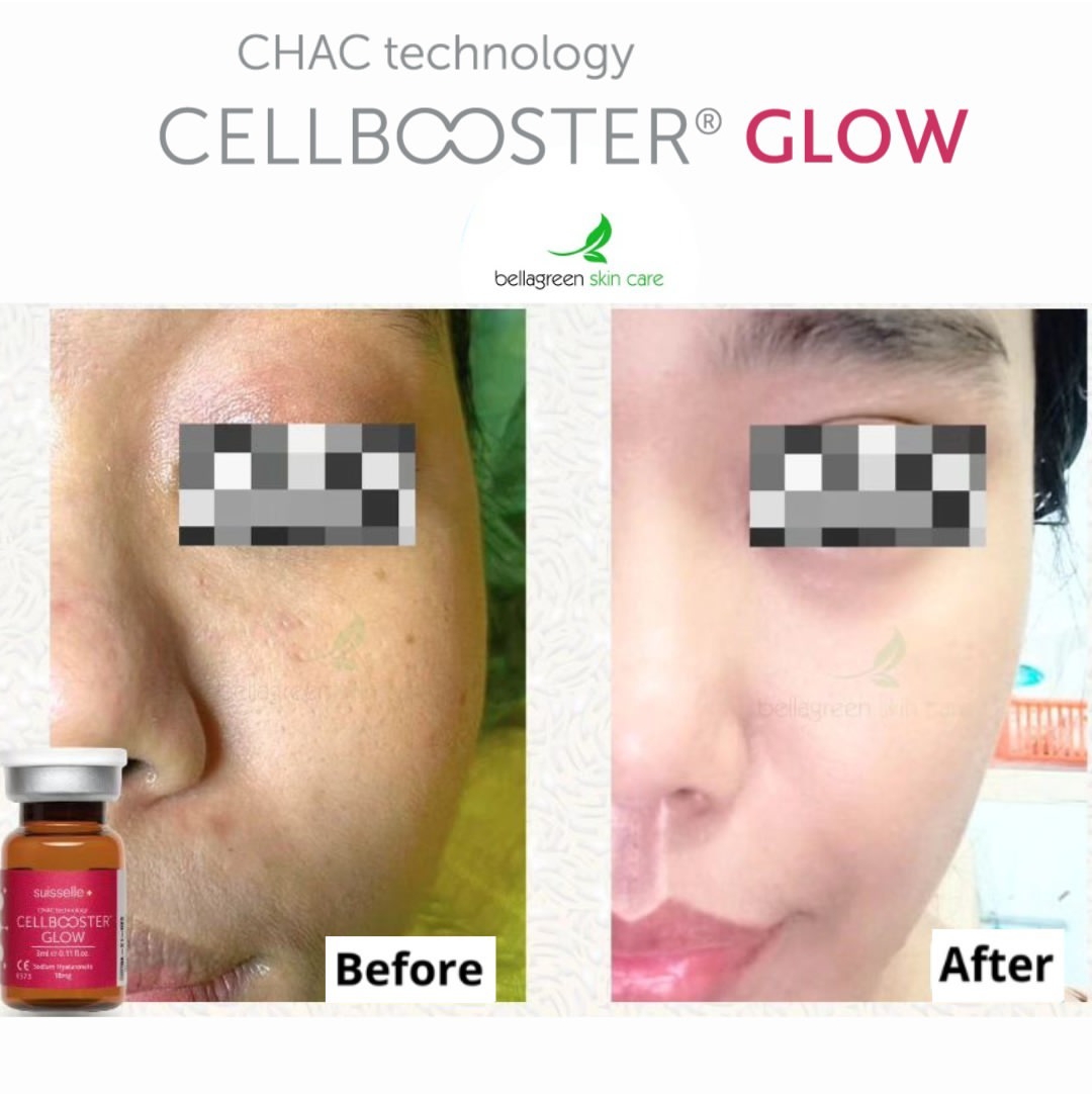 mengatasi flek hitam di wajah