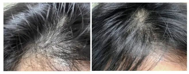 rambut rapuh