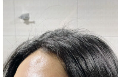 rambut rontok pada wanita