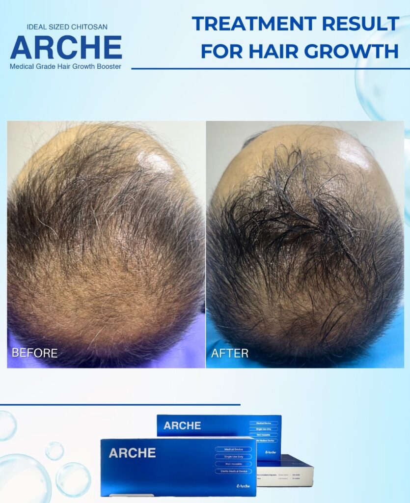 Penyebab Kepala Botak