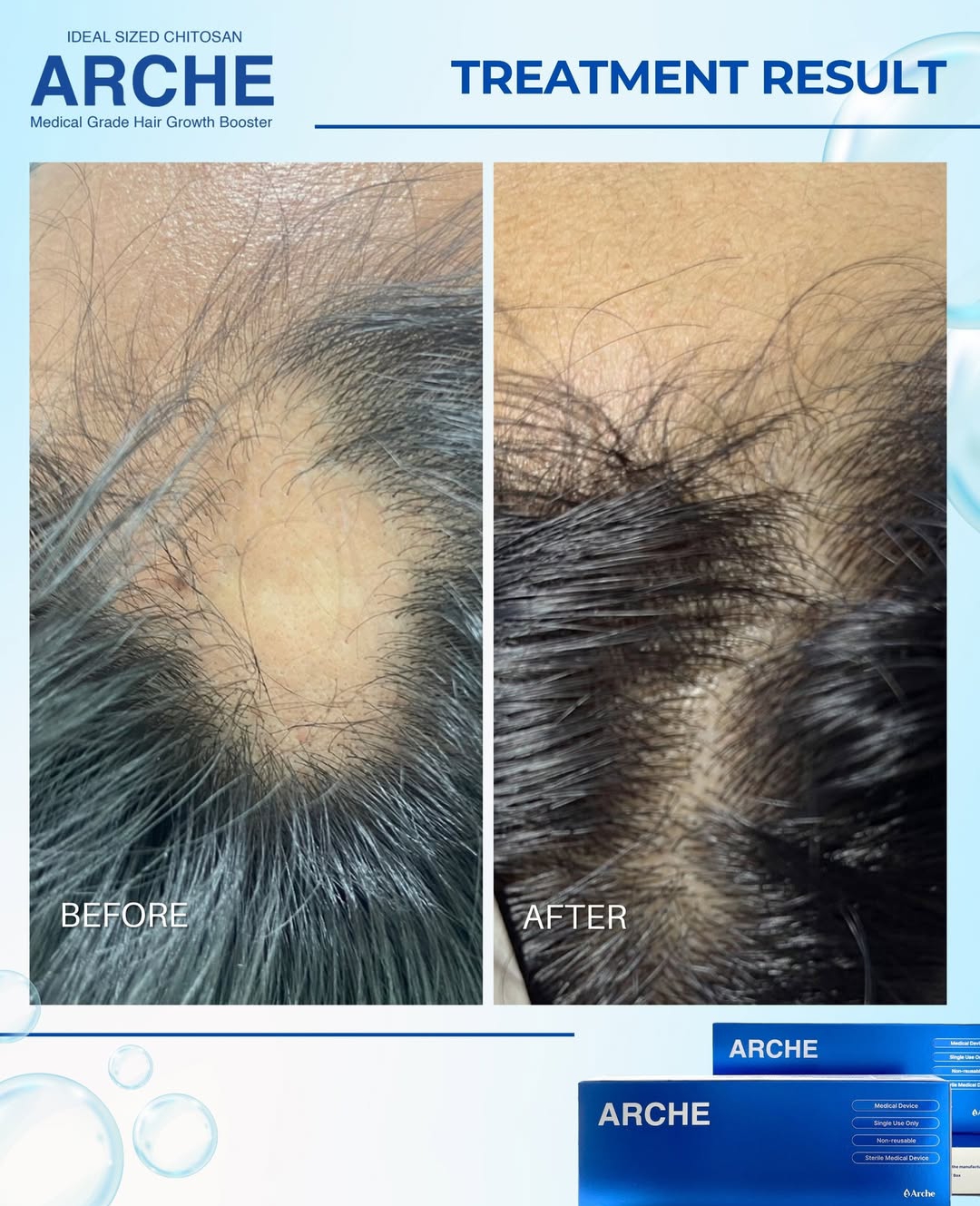 alopecia adalah