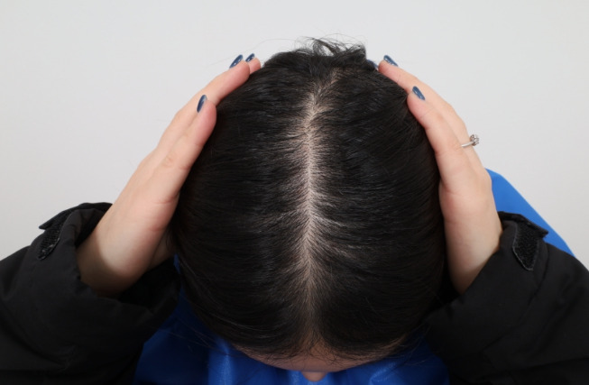 Perawatan Rambut Rontok Keenam