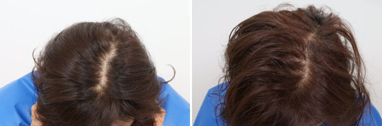 Rambut Mengalami Kerontokan