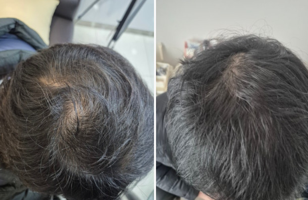 Perawatan Rambut Rontok ARCHE