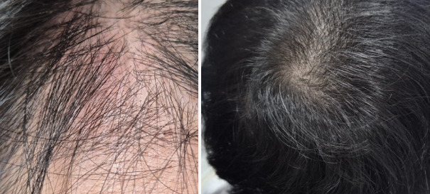 Perawatan Rambut Rontok ARCHE
