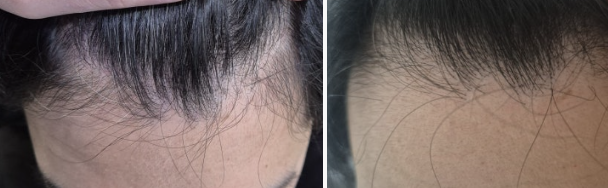 Perawatan Rambut Rontok ARCHE