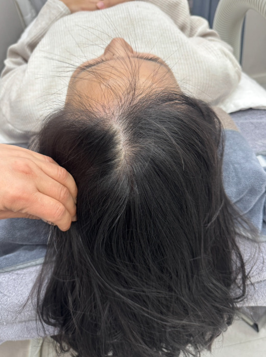 rambut pasca melahirkan