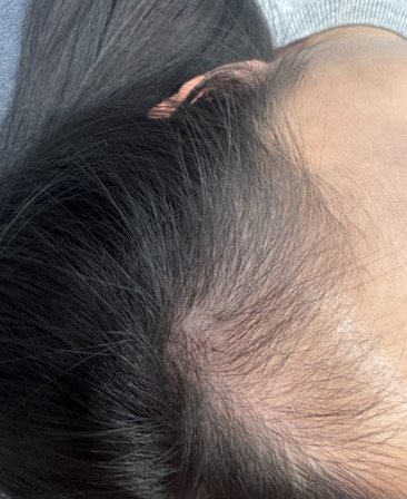 rambut pasca melahirkan