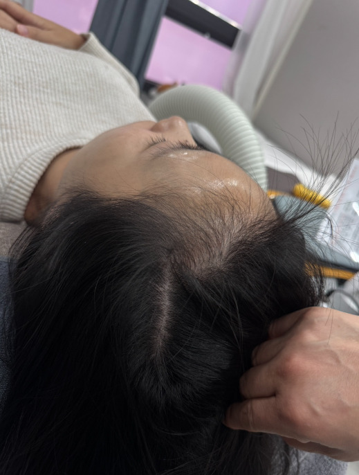 rambut pasca melahirkan