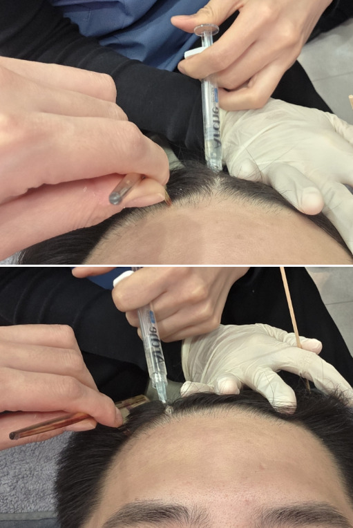 Perawatan Rambut Rontok Menggunakan ARCHE