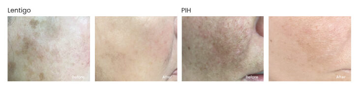 Before & After Picocare Majesty Treatment
