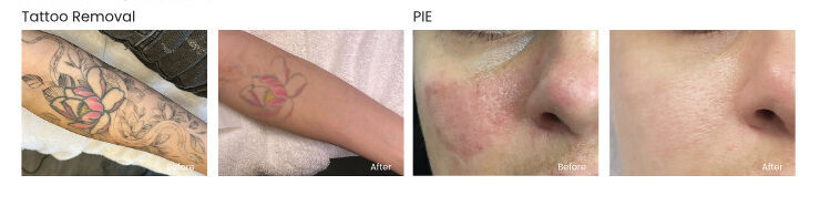 Before & After Picocare Majesty Treatment