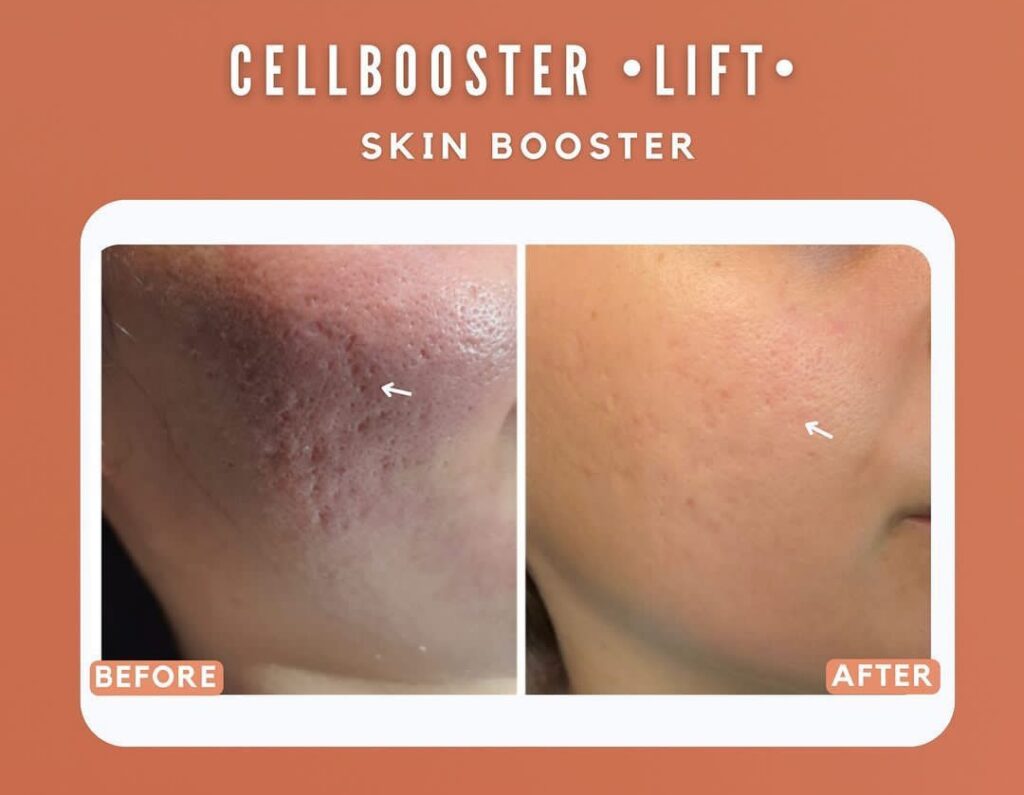 bekas jerawat berlubang