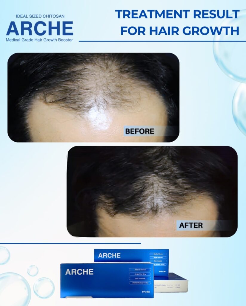 cara menumbuhkan rambut berbentuk M