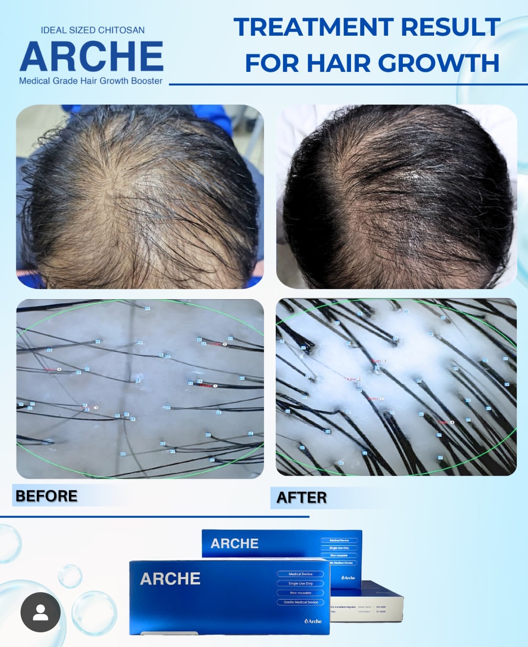 cara biar rambut tebal