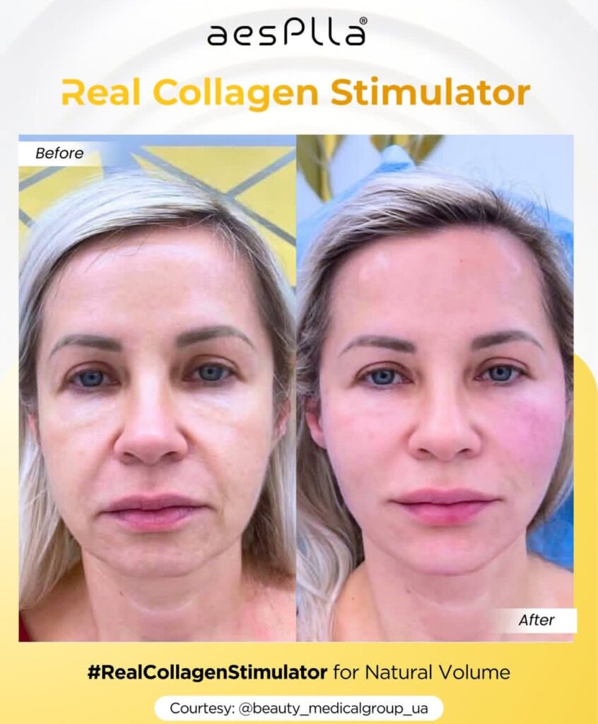 kolagen stimulator aesPlla