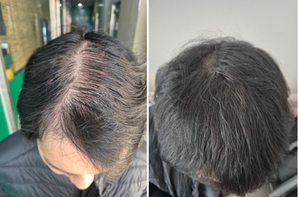 Solusi Ampuh untuk Masalah Rambut Rontok