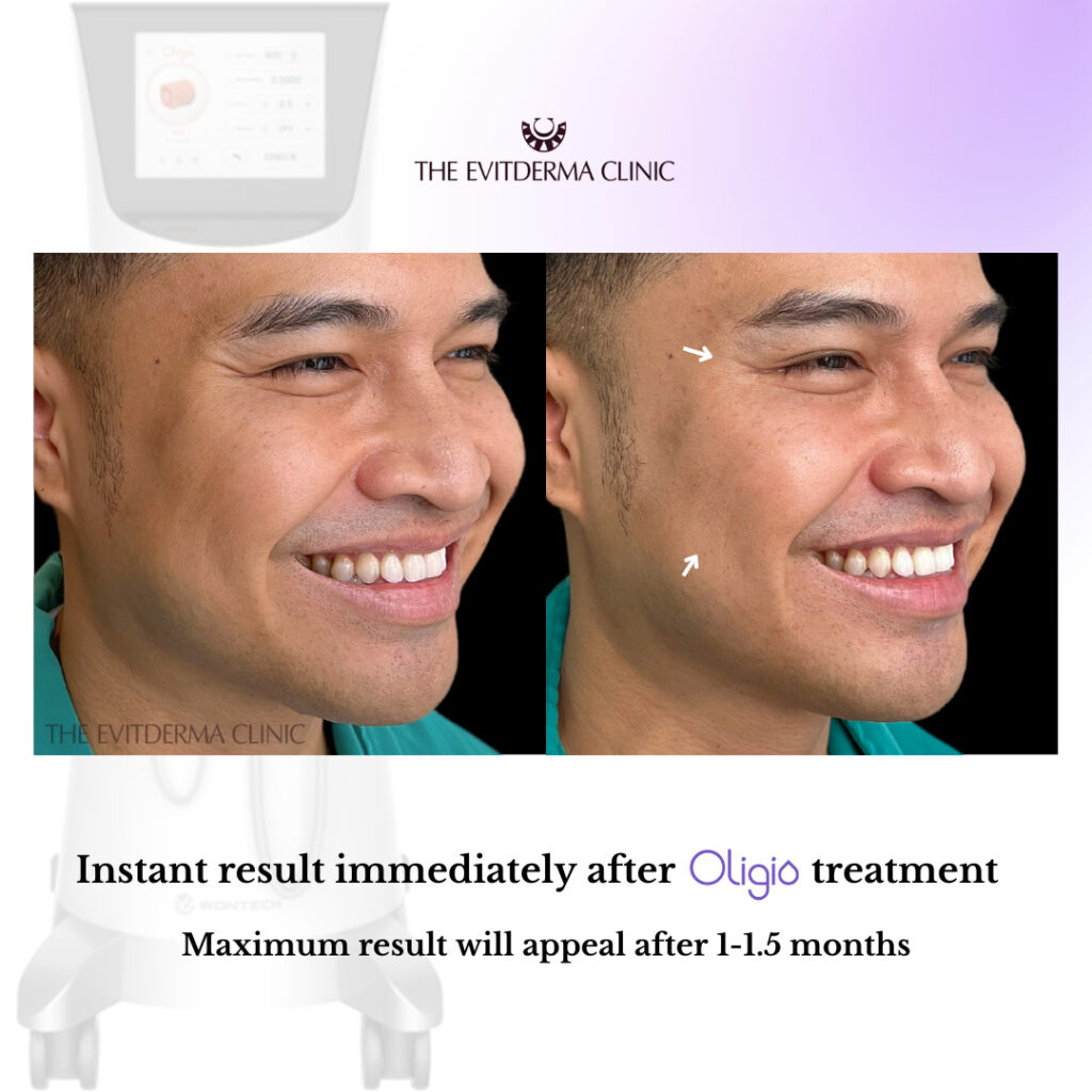 radio frequency treatment adalah