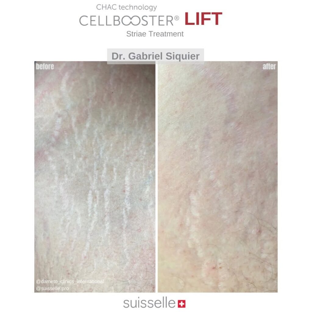 striae adalah