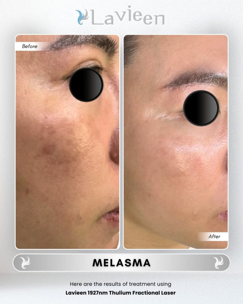 perawatan melasma