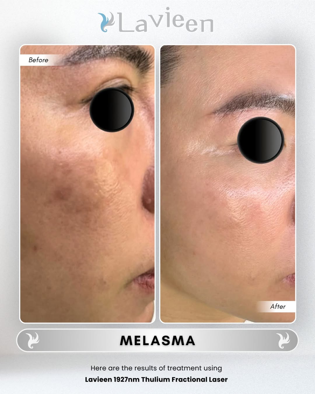 melasma pada wajah