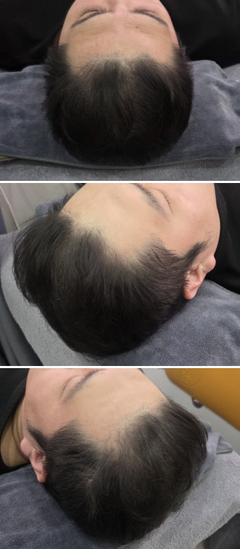 Perawatan Rambut Rontok ARCHE