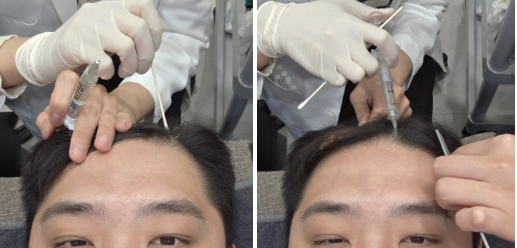 sesi perawatan rambut rontok