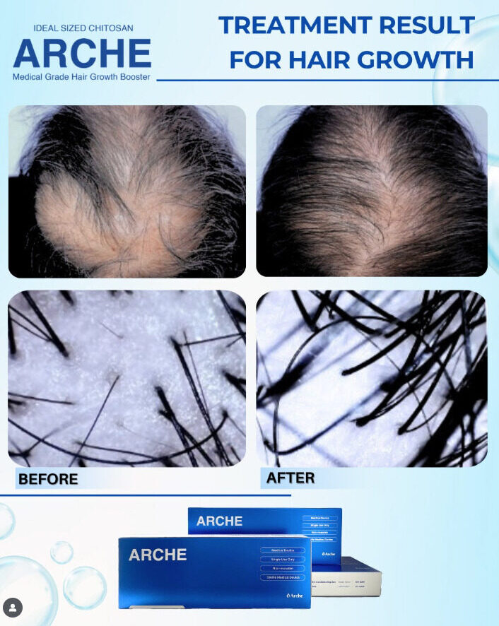 penyebab rambut botak