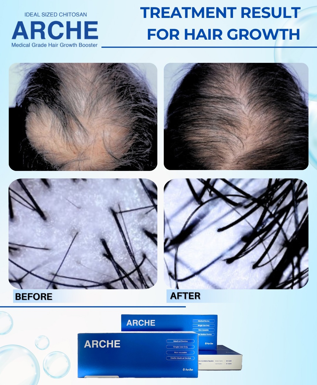 cara menumbuhkan rambut botak pada wanita