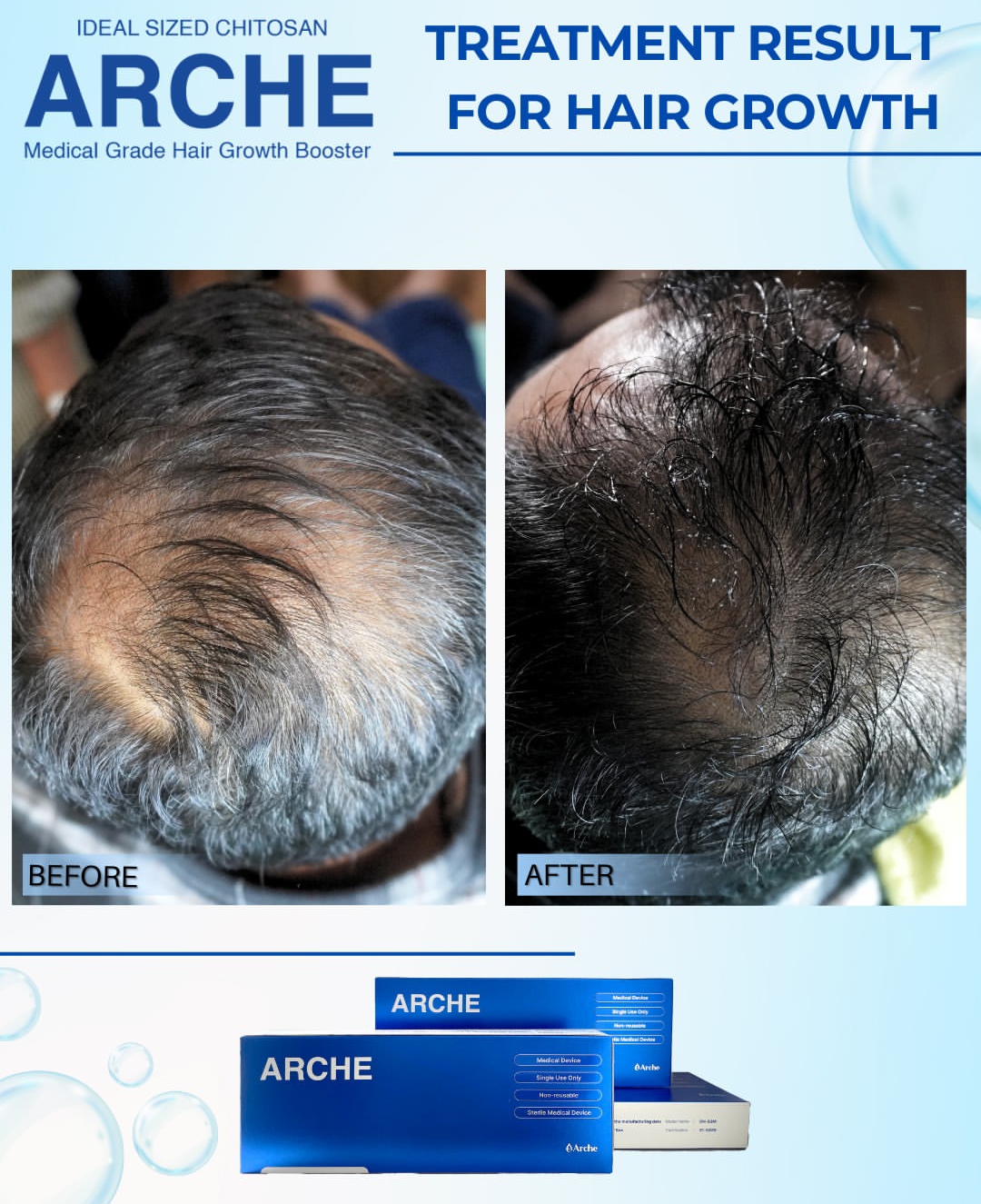 cara menumbuhkan rambut rontok