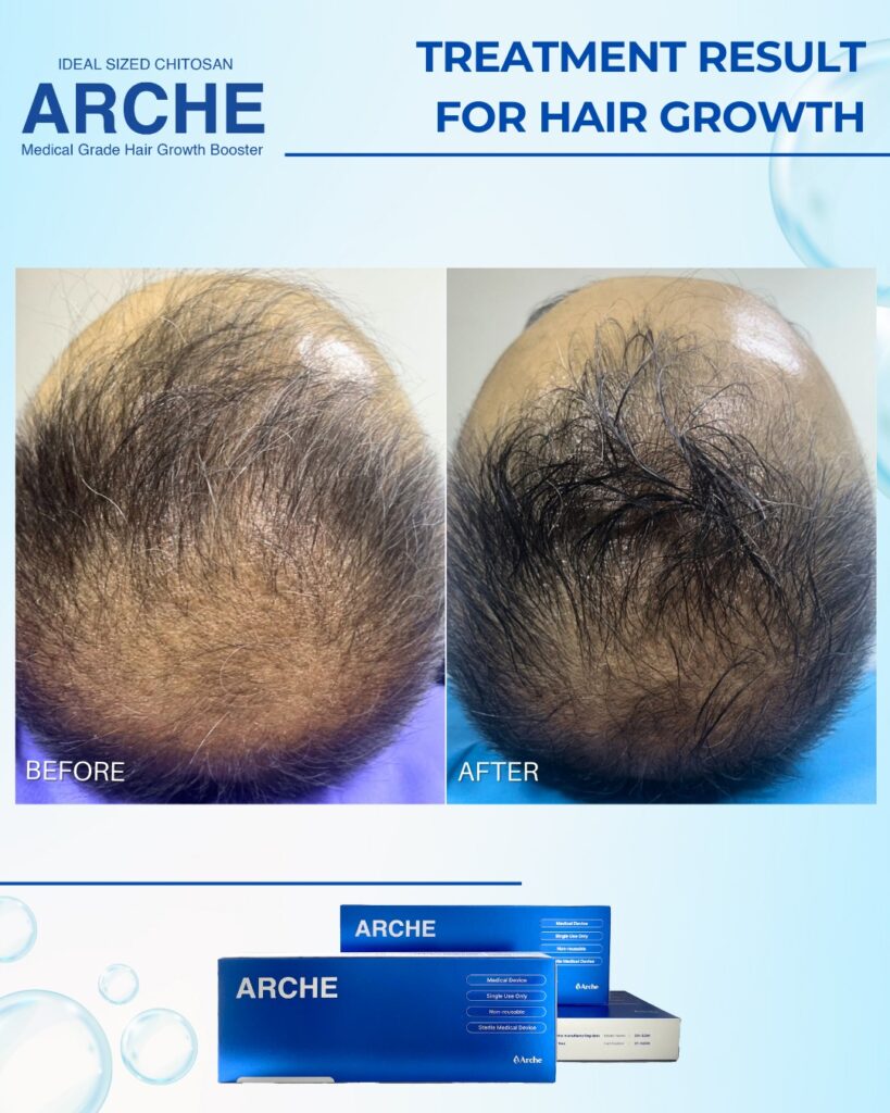 penyebab rambut botak tengah pada pria