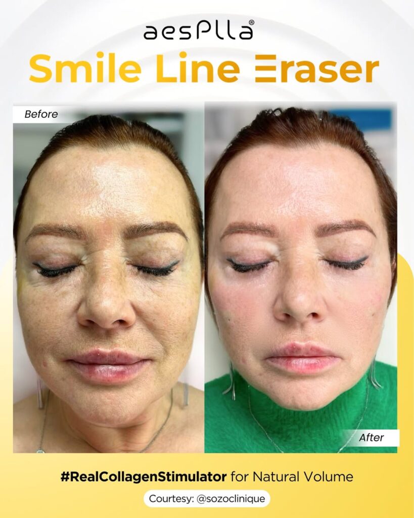skincare untuk menghilangkan garis senyum
