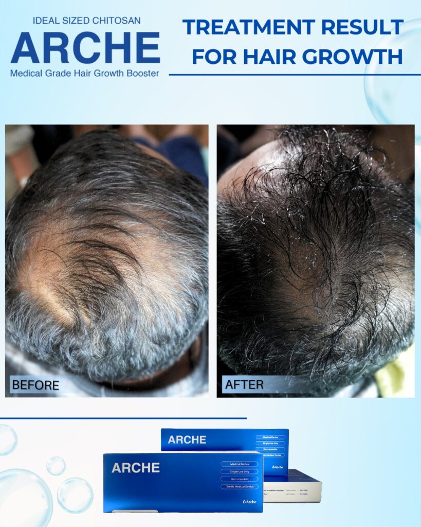 mengatasi rambut botak