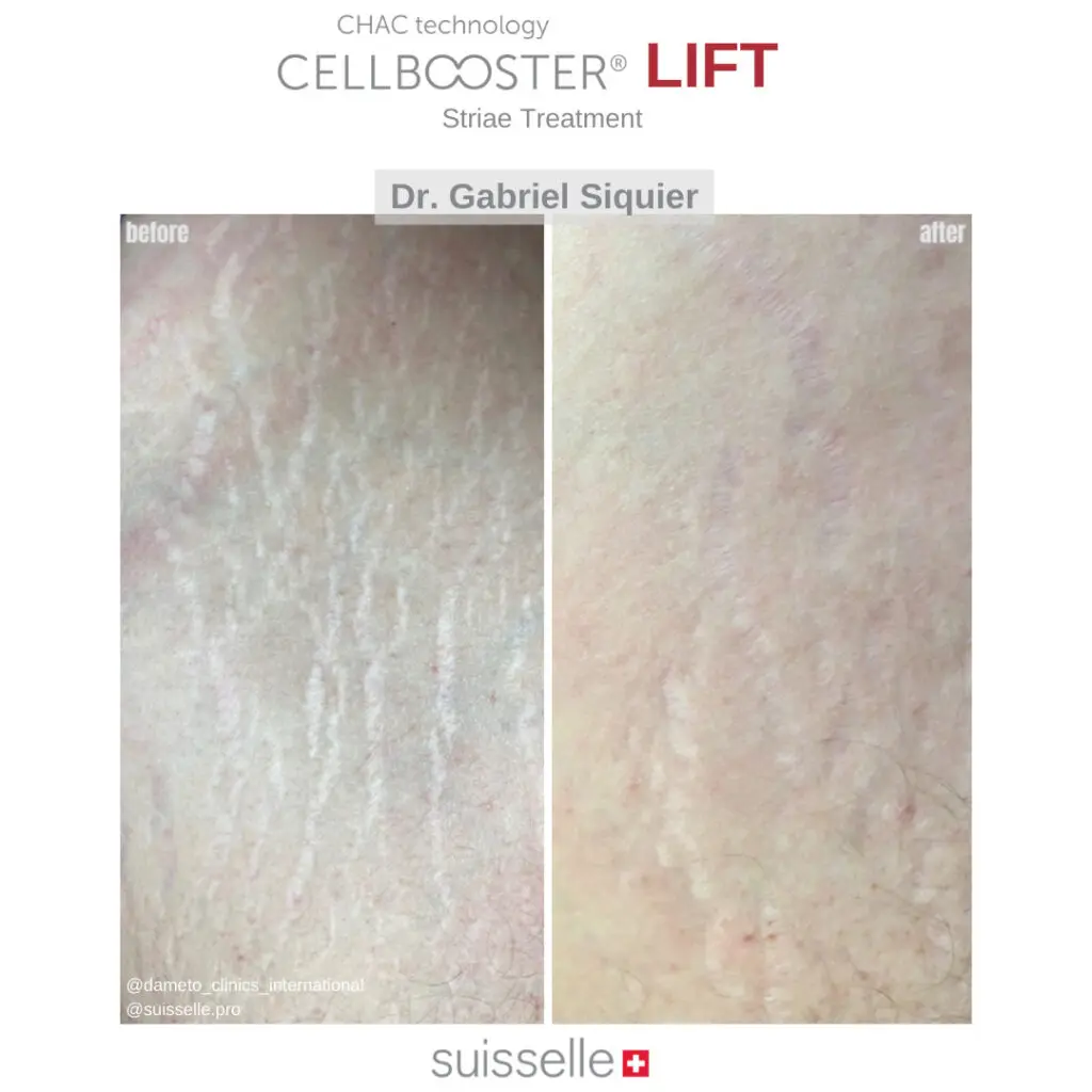 Stretch Mark Perut