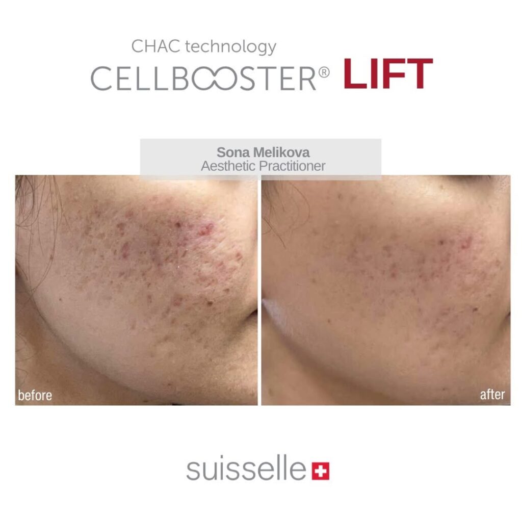 Cara Menghilangkan Bopeng Bekas Jerawat di Pipi