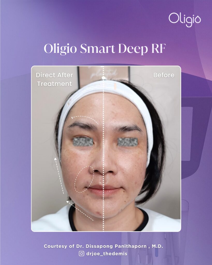 mengencangkan muka