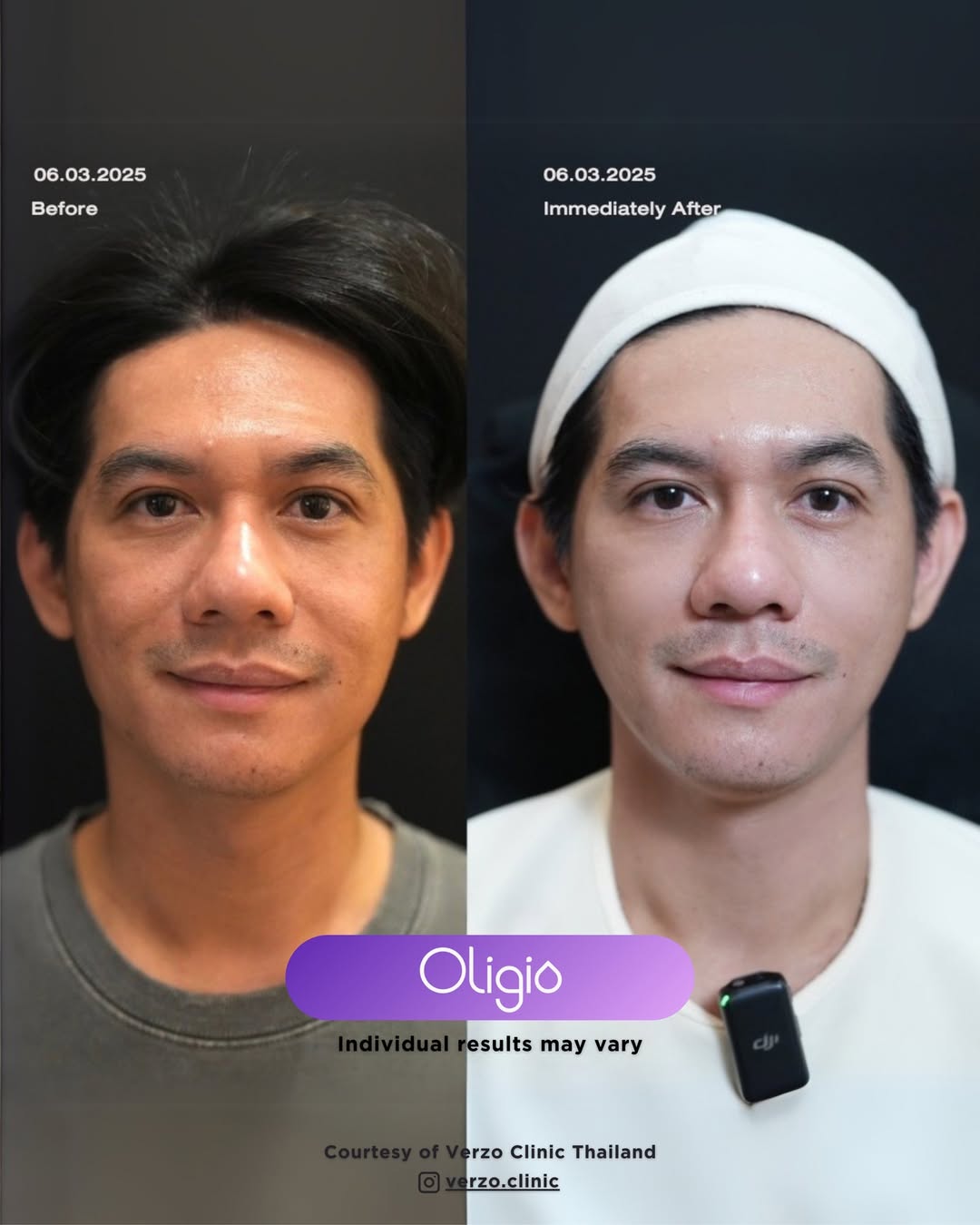 radio frequency facial