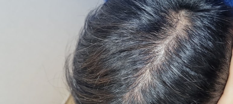 Rambut Rontok ARCHE