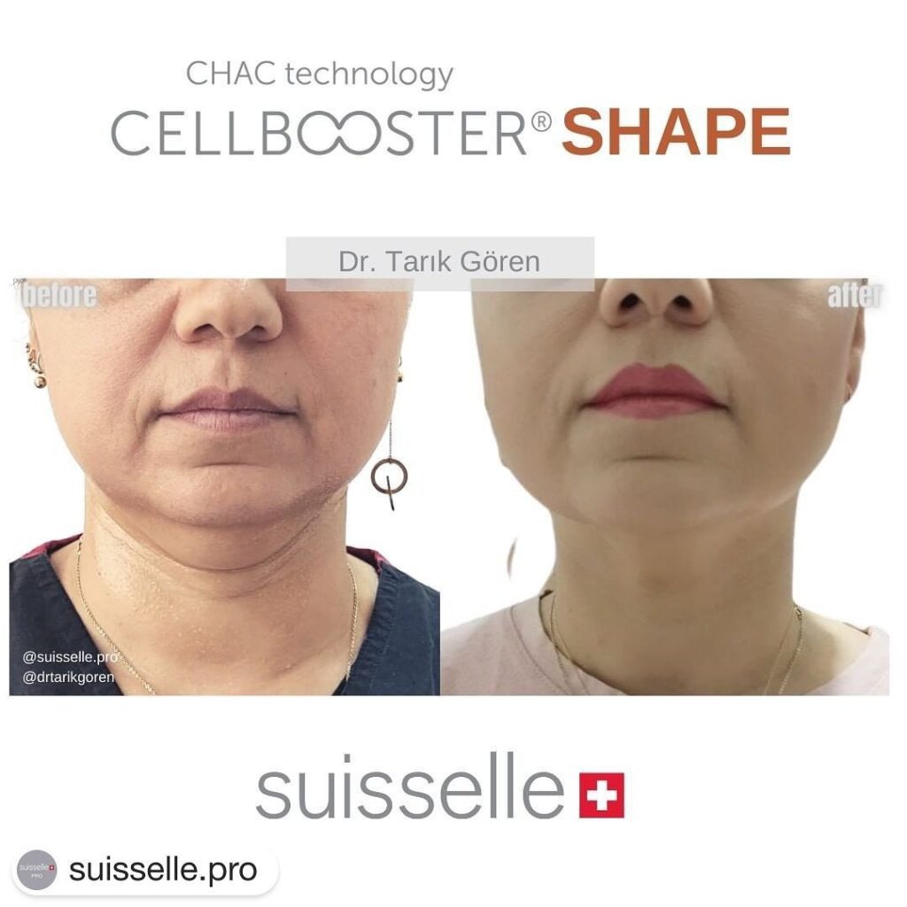 hilangkan double chin