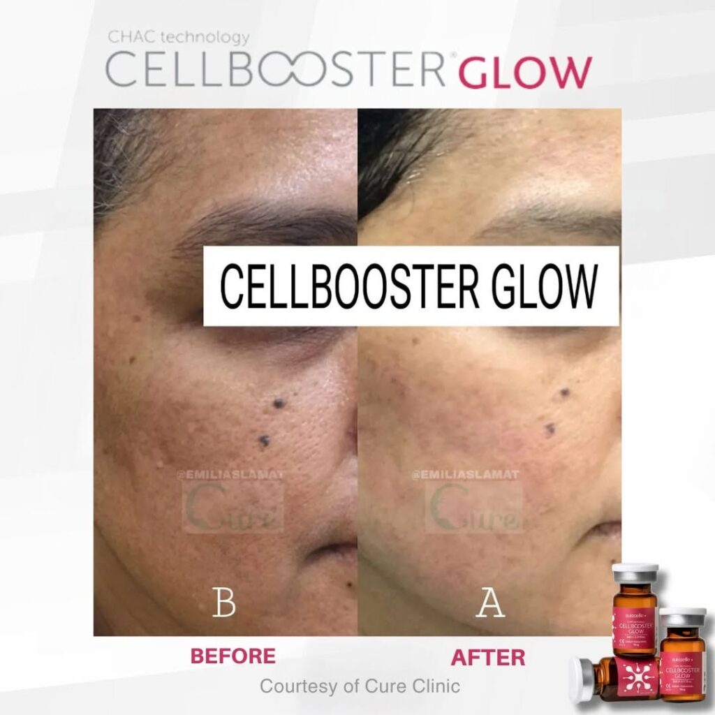 Hiperpigmentasi Wajah