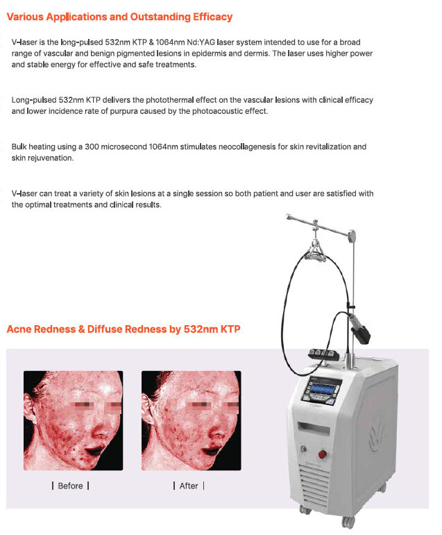 the key features of V-Laser