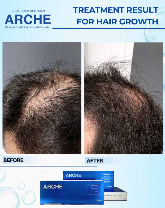 perawatan alopecia areata