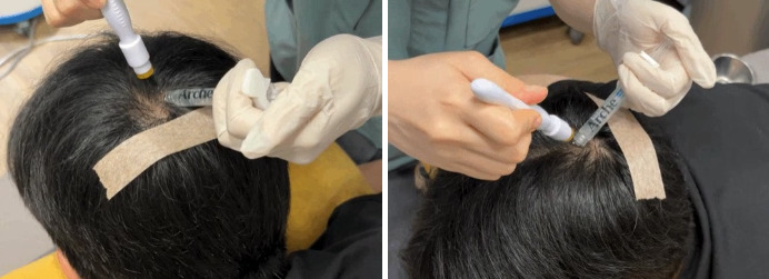 Cara Mengatasi Kerontokan Rambut