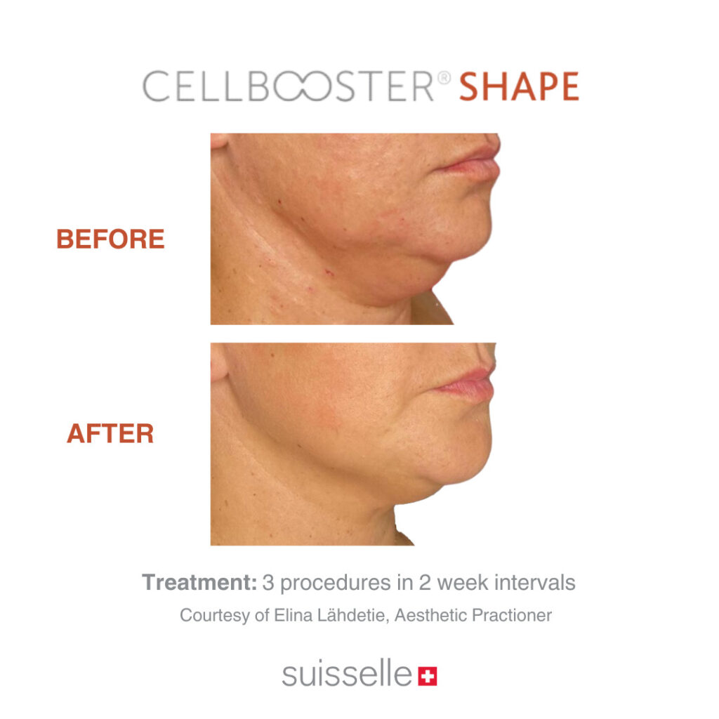 Penyebab Double Chin dan Cara Mengatasinya